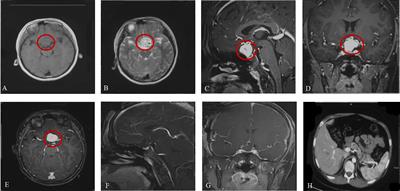 Central Nervous System Hemangioblastoma in a Pediatric Patient Associated With Von Hippel-Lindau Disease: A Case Report and Literature Review